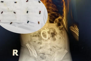 Nghệ An: Cấp cứu kịp thời cho bé trai 3 tuổi nuốt 25 viên bi nam châm vào bụng