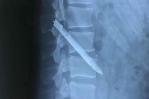 Một chiến sĩ công an phát hiện trong cơ thể mình có lưỡi dao dài đến 13 cm suốt 11 năm