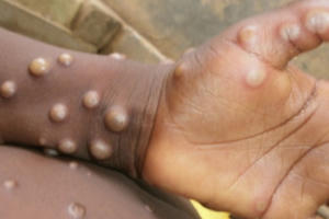 Trường hợp nào được xác định mắc đậu mùa khỉ?