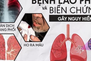 Truyền thông nâng cao ý thức phòng, chống bệnh lao