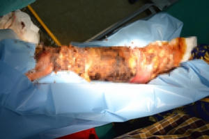 Cánh tay bốc mùi của bệnh nhân bị bỏng tự chữa bằng cách đắp thuốc nam