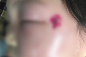 Phú Thọ: Cứu sống bé gái nhiễm khuẩn huyết nặng