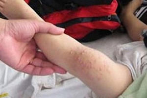 Hà Nội: Gia tăng trẻ mắc cúm A, giám sát tay chân miệng tại 63 bệnh viện