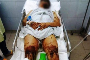 Vụ cắt gân, tạt axit ở Quảng Ngãi: "Thấy chân đau quá, nhìn xuống mới biết chân bị cắt gân"