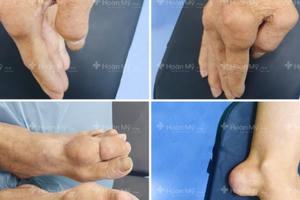 Nam bệnh nhân nhập viện trong đau đớn với tứ chi biến dạng vì bệnh Gout