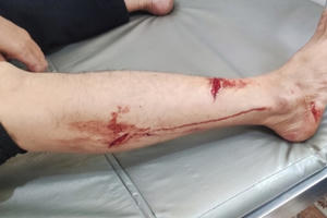 Một người đàn ông bị Voọc đen má trắng cắn khi đang điều khiển xe máy