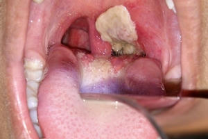 Bộ Y tế khuyến cáo phòng chống bệnh bạch hầu Bộ Y tế khuyến cáo phòng chống bệnh bạch hầu