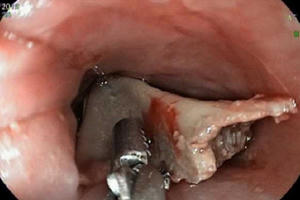 Xem ti vi khi ăn, bé gái bị khúc xương gà chặn ngang cổ