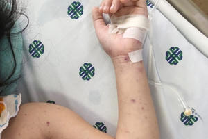 TP.HCM: Khoanh vùng, theo dõi người tiếp xúc với bệnh nhi bị viêm não mô cầu