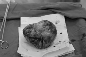 Ca “mổ kép” tách khối u buồng trứng 20 cm và em bé thành công