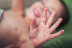 Tỉnh Lâm Đồng có khoảng 150 ca mắc bệnh tay chân miệng