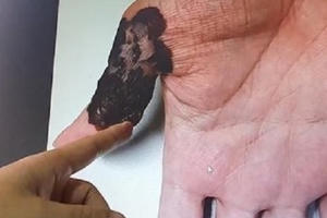 Nốt ruồi  lòng bàn chân, bàn tay nguy cơ mắc ung thư cao