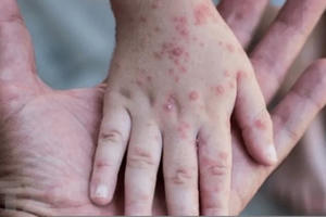 Tổ chức Y tế Thế giới ra khuyến cáo về bệnh đậu mùa khỉ