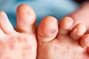 Sốt xuất huyết chưa qua, tay chân miệng lại đến