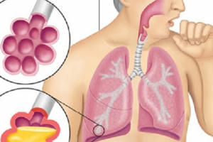 Nấm phổi - căn bệnh nguy hiểm ít người biết