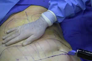 Bệnh viện Bạch Mai: Tiếp nhận thêm một ca tử vong do hút mỡ bụng