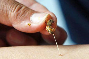 Người phụ nữ suýt mất mạng vì vết ong đốt