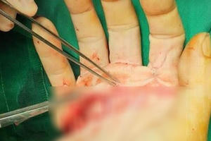 Phẫu thuật cứu bàn tay gần như bị đứt lìa của người thợ nhôm kính