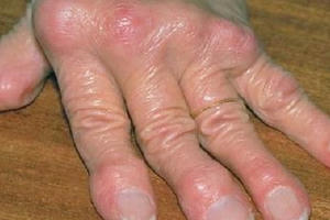 Thực đơn Tết cho người bị bệnh Gout