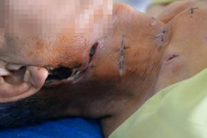 Tự ý đắp lá khi xuất hiện vết sưng, bệnh nhân đái tháo đường bị lở loét nghiêm trọng