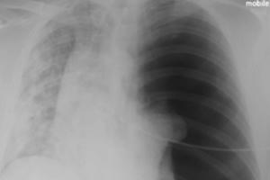 Hình ảnh phổi bị tàn phá của bệnh nhân Covid-19 36 tuổi