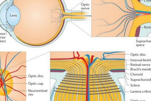 Xác định được 40 chuỗi ADN gây bệnh glaucoma dẫn tới mù lòa