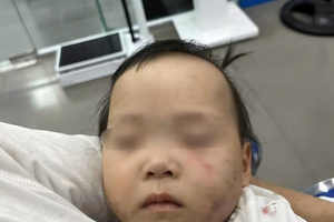 Bé gái 1 tuổi bị bầm tím mặt khi gửi nhà trẻ ở Bắc Ninh: Tạm giữ hình sự cô giáo