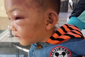 Bé trai 2 tuổi nhập viện với nhiều vết thương nghi do bị cha dượng đánh đập