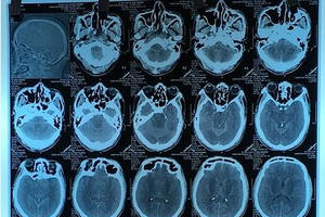 Tử vong vì uống cồn thay rượu