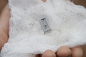 Bé 8 tuổi tím tái vì đồ chơi xếp hình lọt vào phế quản