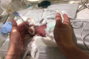 Em bé sinh non nhỏ nhất thế giới chỉ nặng bằng một quả cam