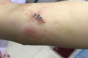 Tưởng viêm da cơ địa không ngờ mắc ung thư tế bào lympho T