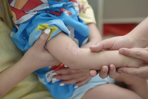 Hà Nội ghi nhận các ổ dịch tay chân miệng tại trường mầm non