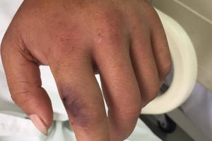 Bác sĩ cảnh báo mùa rắn độc