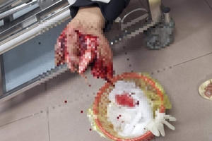 Pháo phát nổ khiến một thiếu niên nát bàn tay