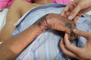 9 ca hoại tử vì liên cầu lợn do ăn tiết canh và tiếp xúc với lợn bệnh