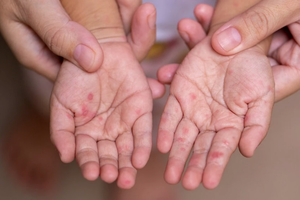 Thủ tướng yêu cầu đẩy nhanh tiêm chủng vaccine phòng, chống bệnh Sởi