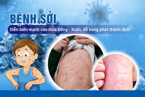 Thủ tướng Chính phủ yêu cầu tăng cường công tác phòng, chống bệnh sởi