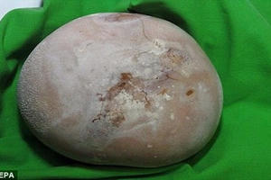 Giật mình sỏi thận to bằng quả trứng vì tự ý chữa bằng thuốc Nam