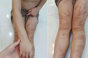 Nghệ An: Nhiều trẻ mầm non bị đánh thâm tím khắp cơ thể