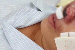 Vi khuẩn ăn thịt người Whitmore có thể gây tử vong trong vòng 48 tiếng