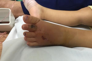 Mùa rắn sinh sản, nhiều bệnh nhi bị rắn độc cắn