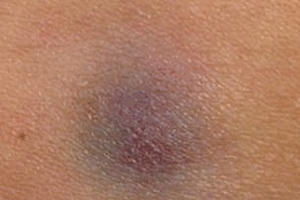 Vết bầm 1 cm kéo dài suốt 6 năm hóa ra là 1 căn bệnh ung thư hiếm gặp