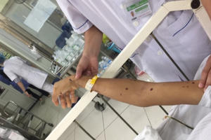 Bị ong đốt phải làm gì?