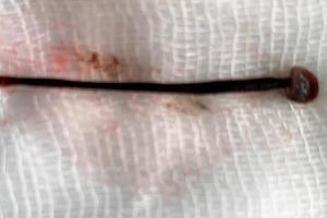 Nữ sinh viên rửa mặt ở suối bị đỉa chui vào mũi