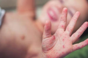 Bến Tre: Xuất hiện ca tử vong đầu tiên do tay chân miệng