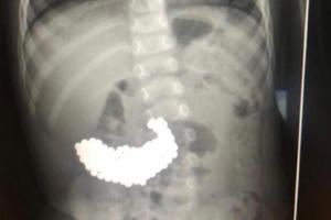 Cứu sống bé trai nuốt 209 viên bi nam châm vào bụng