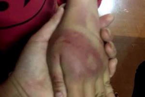 Rùng mình bố đẻ nghiện ngập hành hạ bé gái thâm tím người