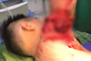 Nghệ An: Đi tắm biển Cửa Lò, bé trai nhập viện vì va phải chân vịt của thuyền