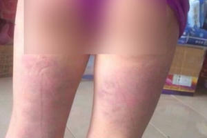 Nghệ An: Khiển trách cô giáo dùng thước đánh học sinh bầm tím người